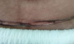 Ini Maitua (sebutan bagi Istri) setelah dia di operasi bekas jahitannya itu memang bagus tapi setelah operasi sampai hari ini perawatannya tidak intens. 